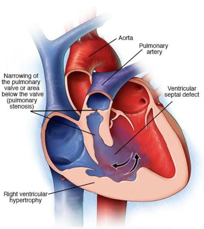 Tetralogy of Fallot