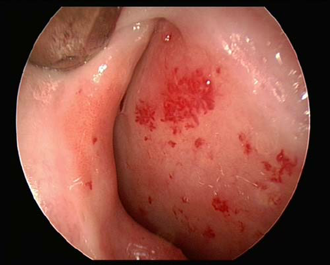 Endoscopic view of the right nasal septum in a 13-year-old.