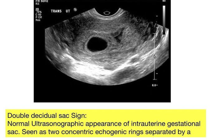 Double Decidual Sac Sign