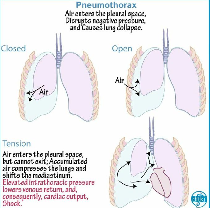 Pneumothorax