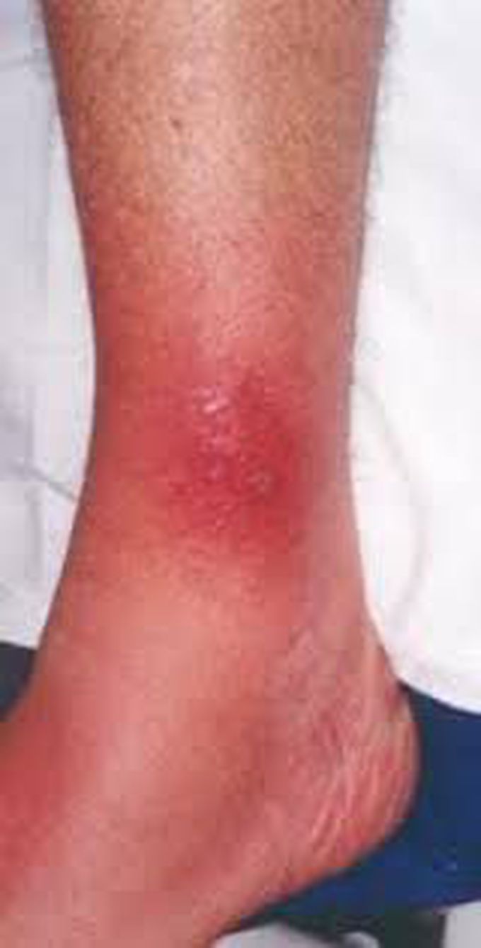 Causes of cellulitis