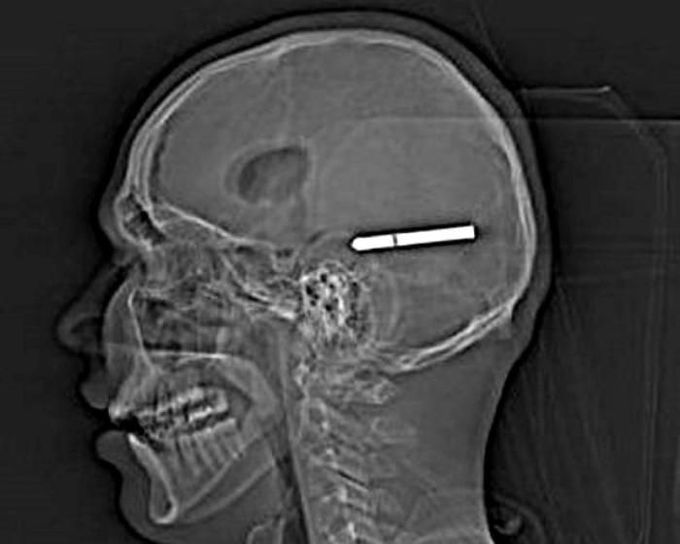 X ray
