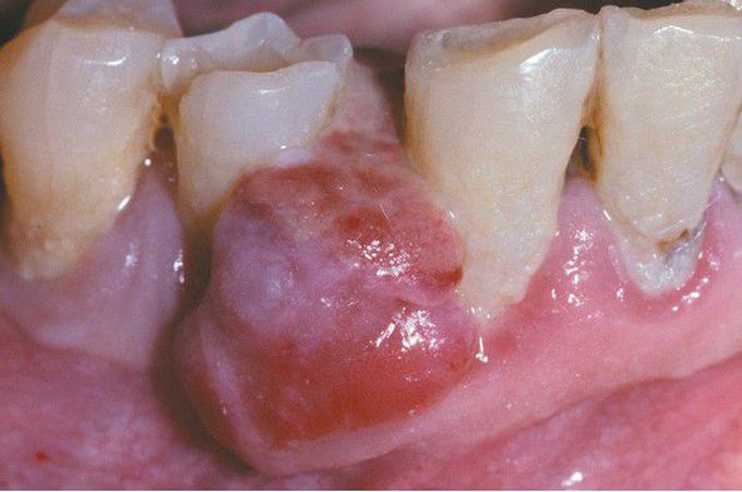 Peripheral Giant Cell Granuloma