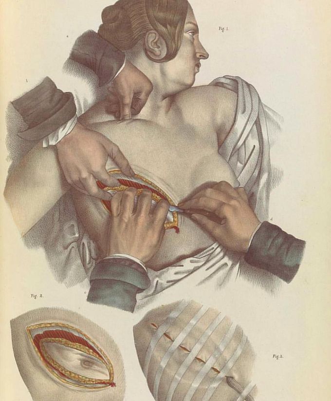 Mastectomy