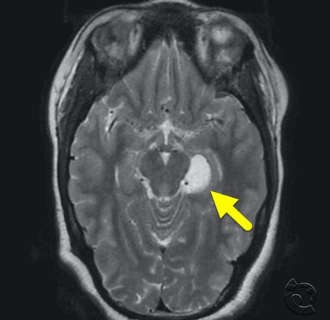 Neurosurgery