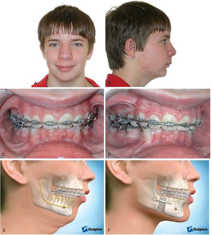 Mandibular advancement