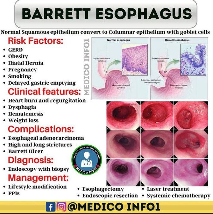 Barret esophagus