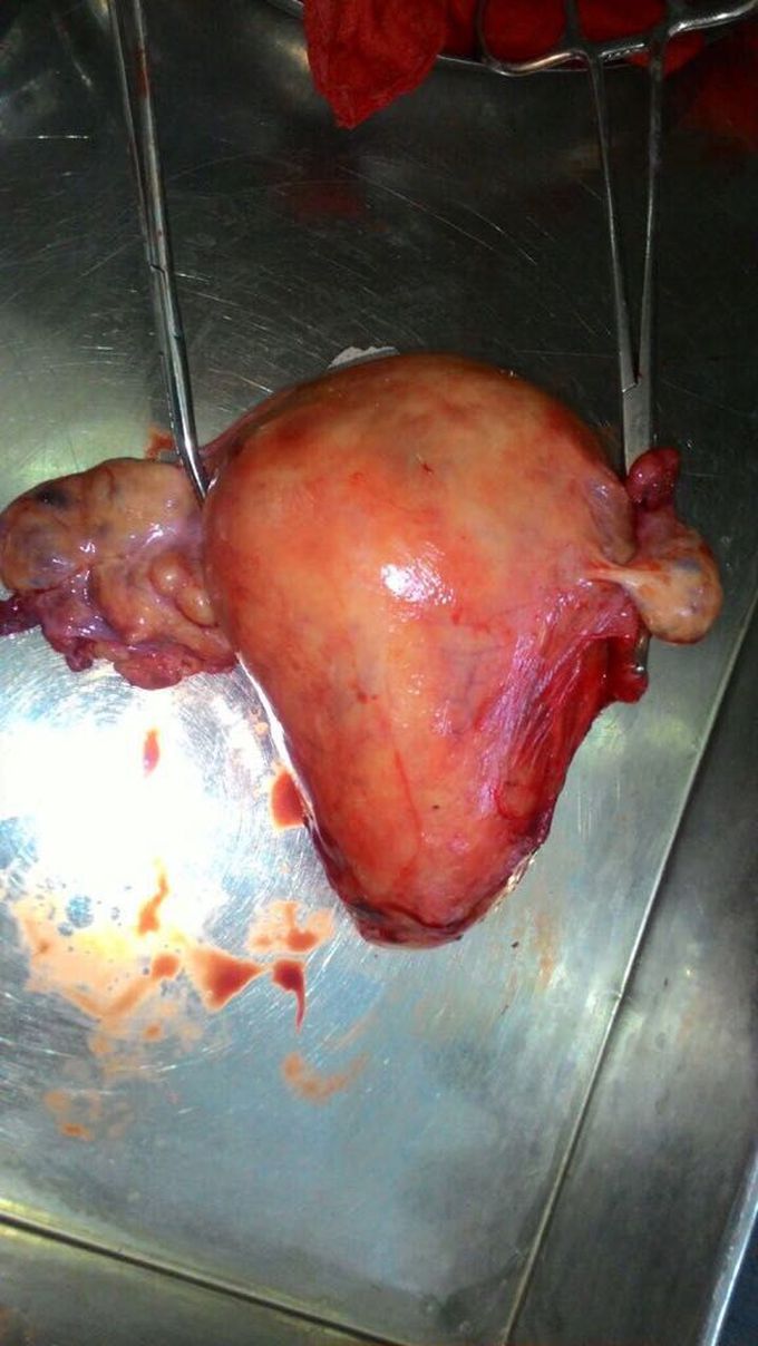 hysterectomy