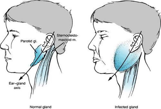 Parotitis