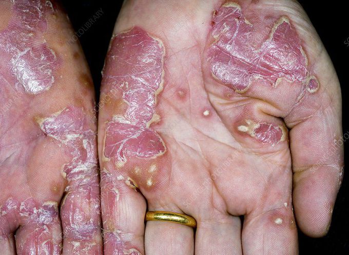 PSORIASIS