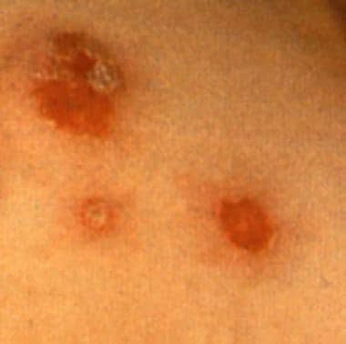 Prevention of spread of impetigo