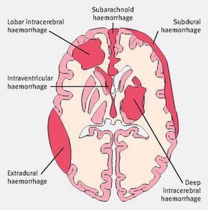 Hemorrhages!