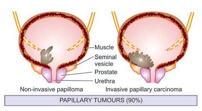 Epithelial bladder tumor