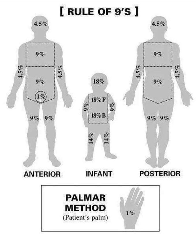 Rule of 9 and Palmer Method