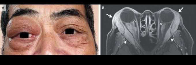 IgG4-Related Ophthalmic Disease