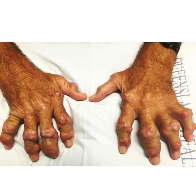 Gouty arthritis