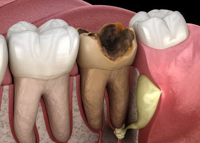 Sign and symptoms of tooth abscess