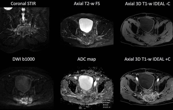 Colon cancer MRI - MEDizzy