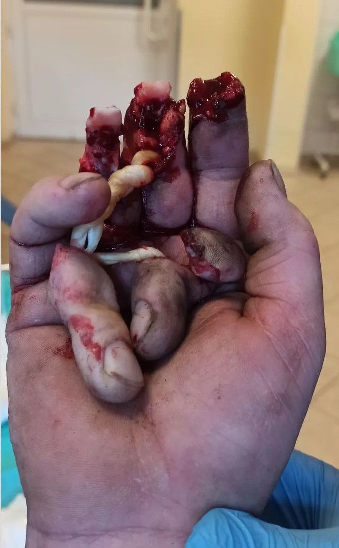 hand DISEASES orthopedic surgery
