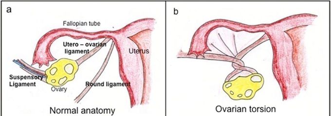 Ovarian torsion