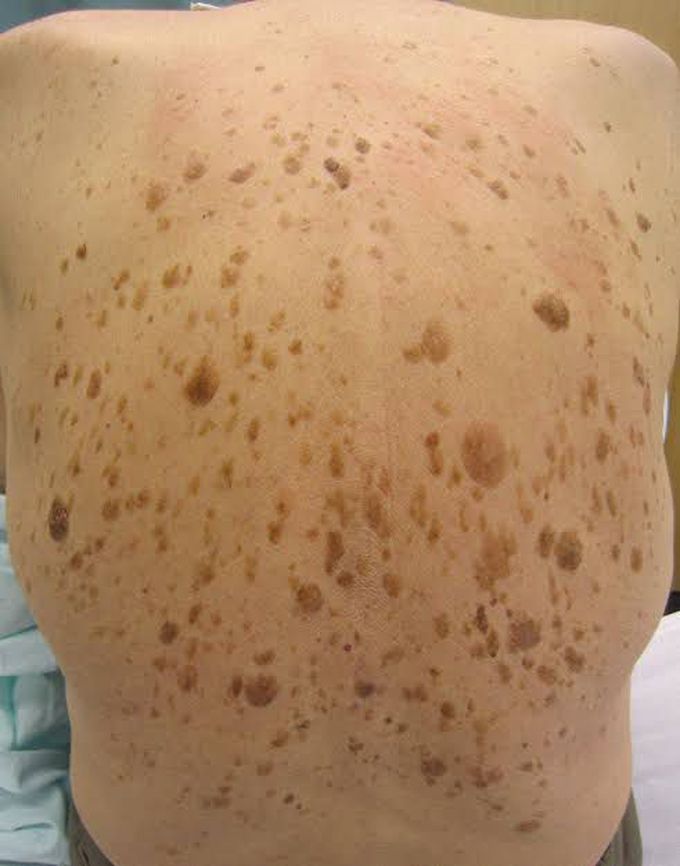 Actinic keratosis MEDizzy