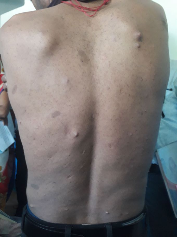 Multiple lipomatosis
