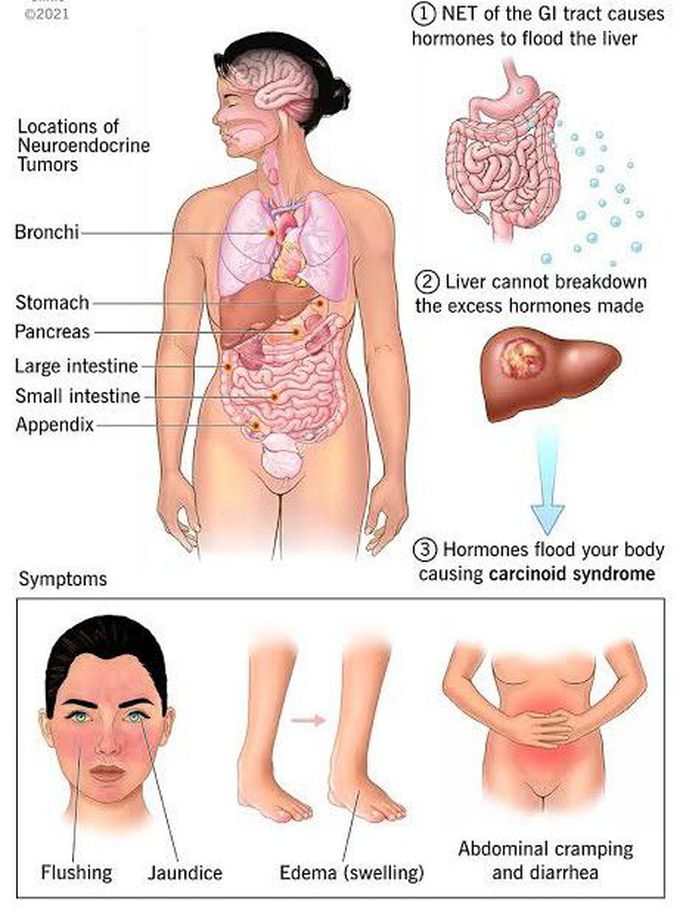 Carcinoid syndrome