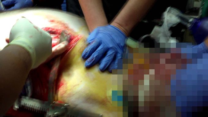 Open Thoracotomy (Viewer Discretion Advised)