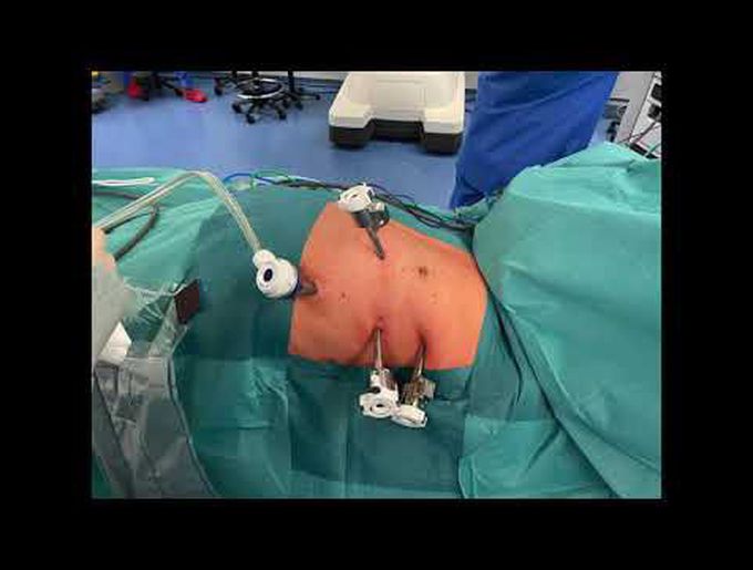 Preoperative Localization and Robotic ROLL-Guided Biopsy of Internal Mamary Lymph Node