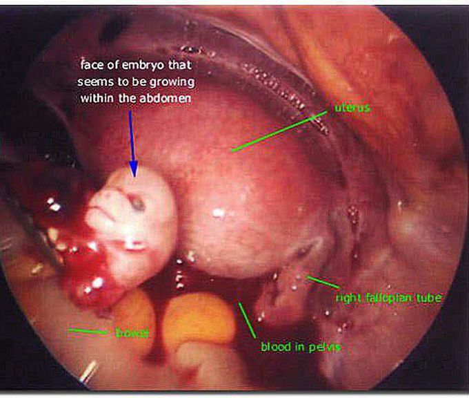 Abdominal pregnancy