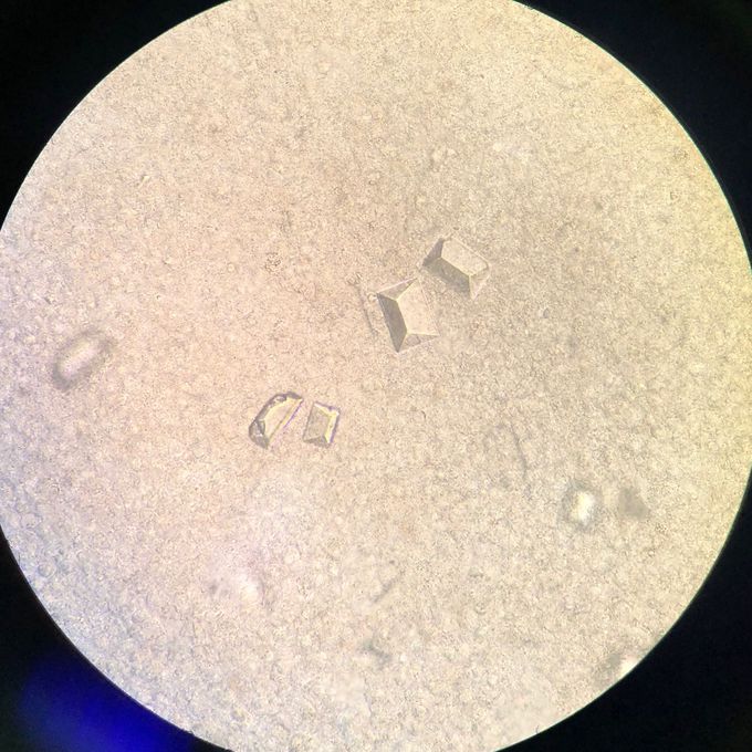You see the triple-phosphate crystals in the microscopy of the urine sediment. These crystals appear after intaking plant foods and mineral waters, in inflammation of the urine bladder.