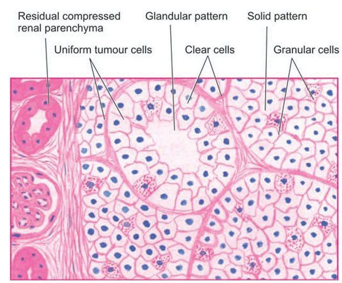 Renal cell carcinoma.