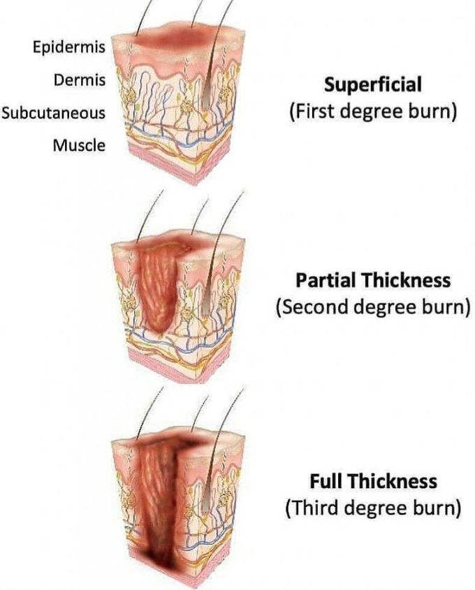 Classification of burn injury depth
