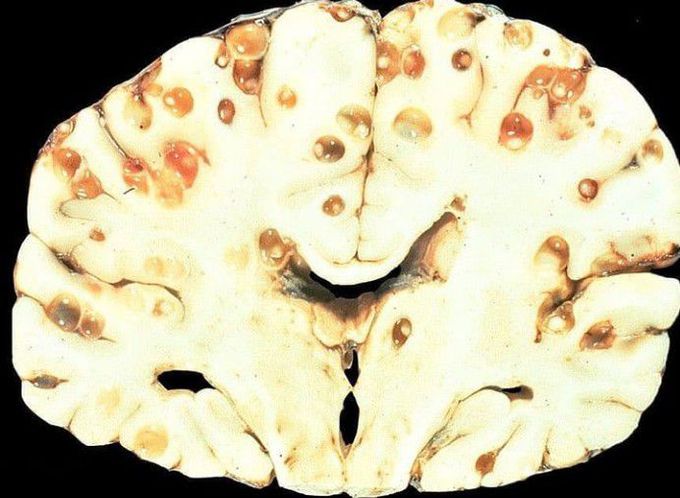 Neurocysticercosis