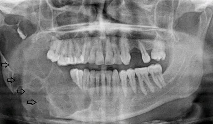 Ameloblastoma