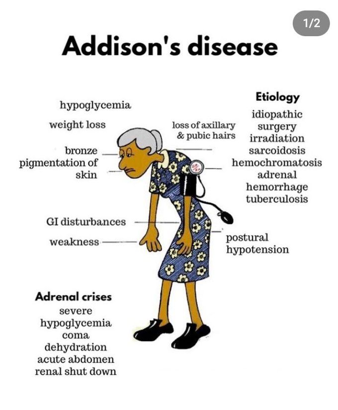 Addisons Disease - Medizzy