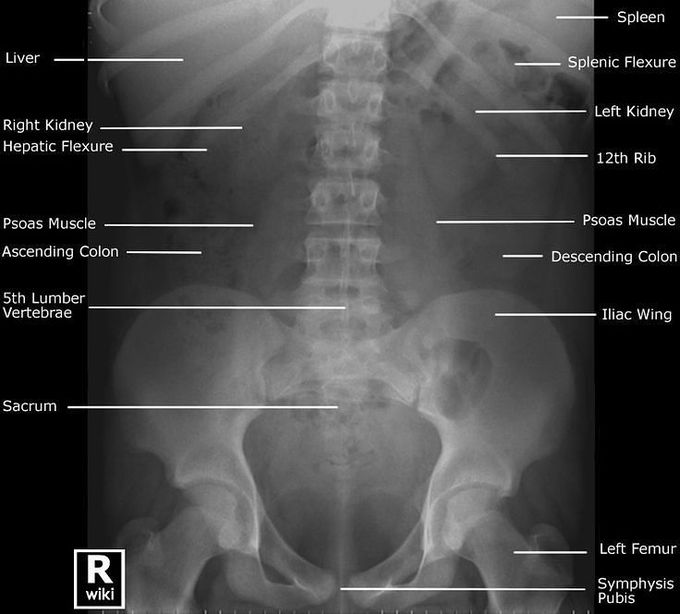 Labeled Plain X-Ray of the abdomen