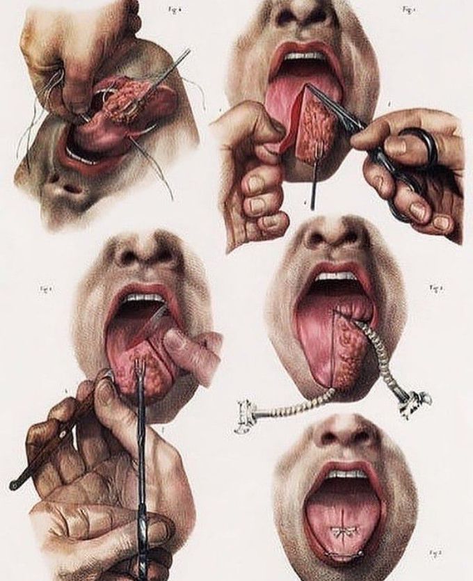 Excision of the Tongue without Anesthesia