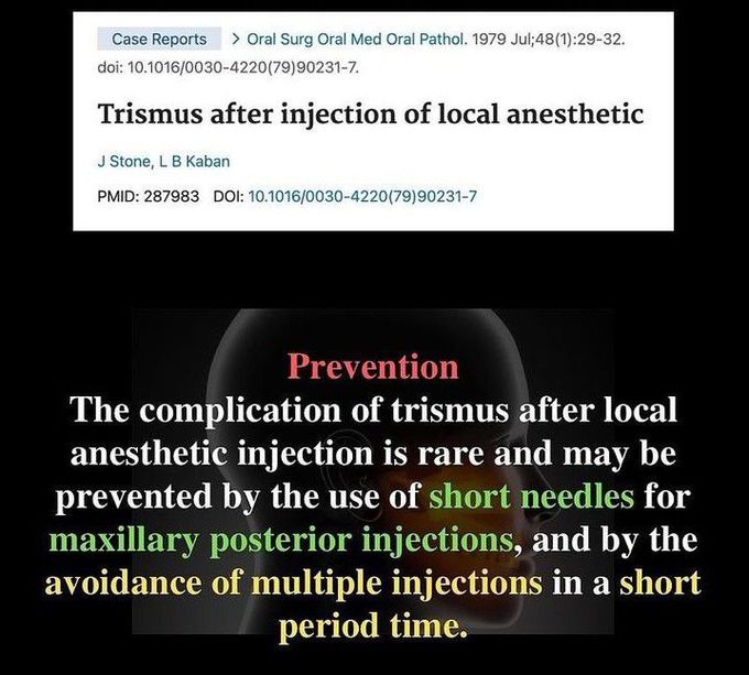 Trismus After Injecting LA- Prevention