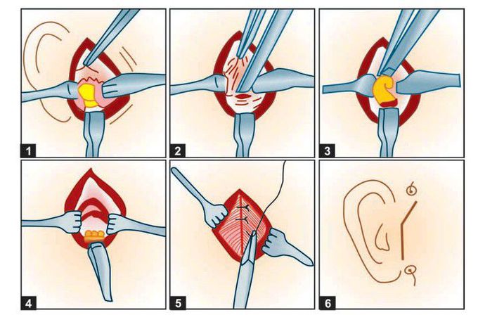 Condylectomy