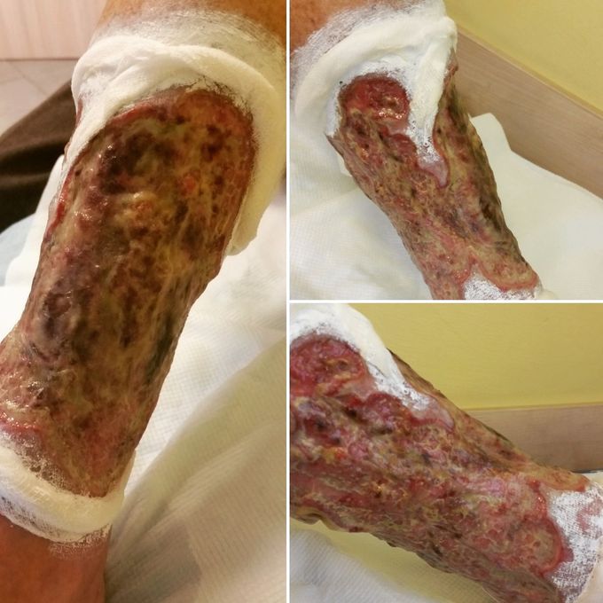 Venous leg ulcer