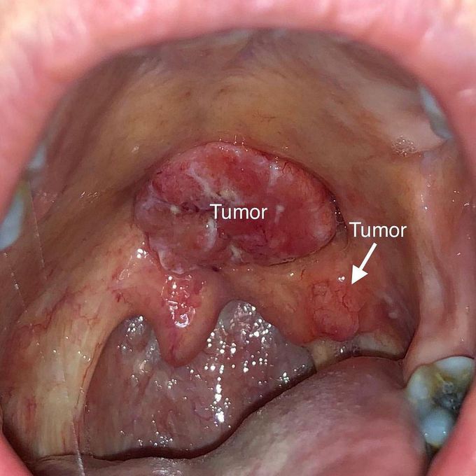 Squamous Cell Carcinoma