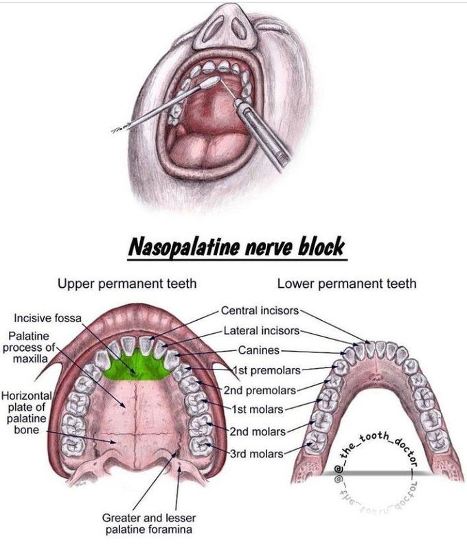 Nasopalatine nerve block