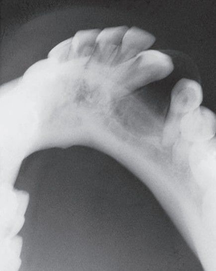 Adenomatoid odontogenic tumor - MEDizzy