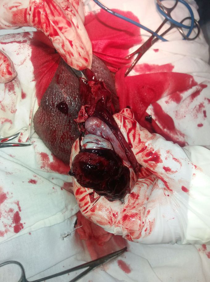 Trauma of orhi