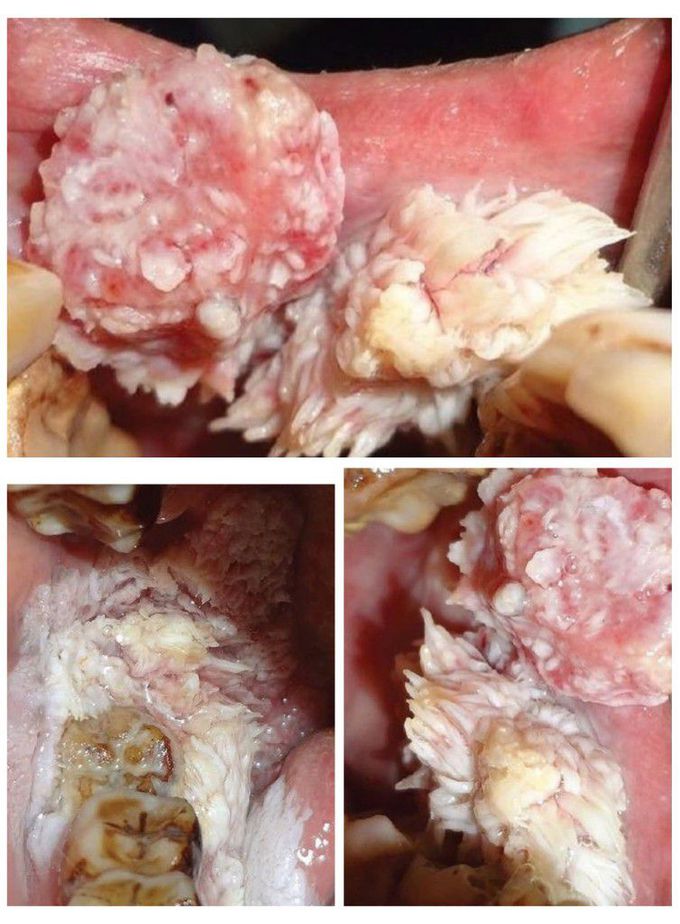 Oral Verrucous carcinoma