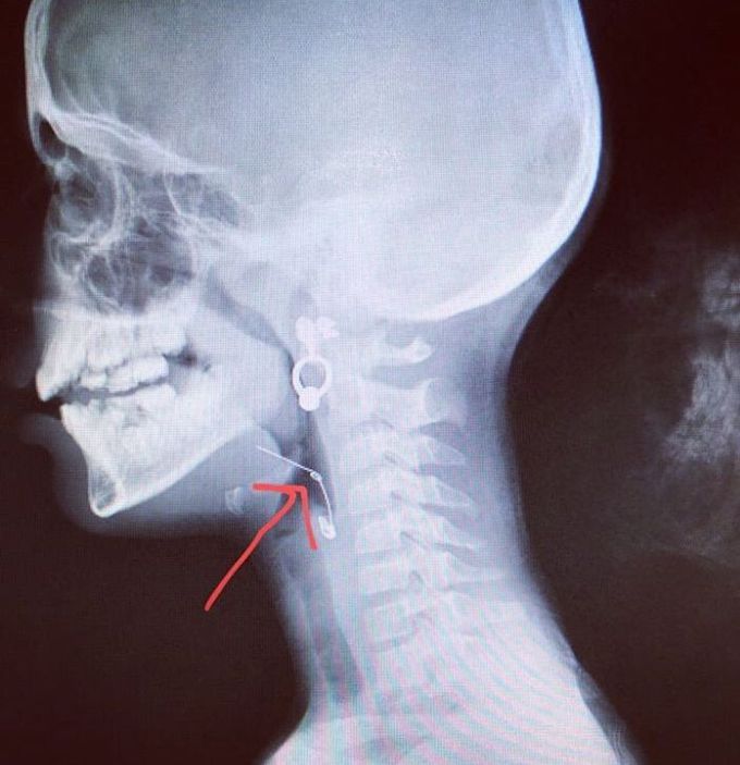 Foriegn body in airway
