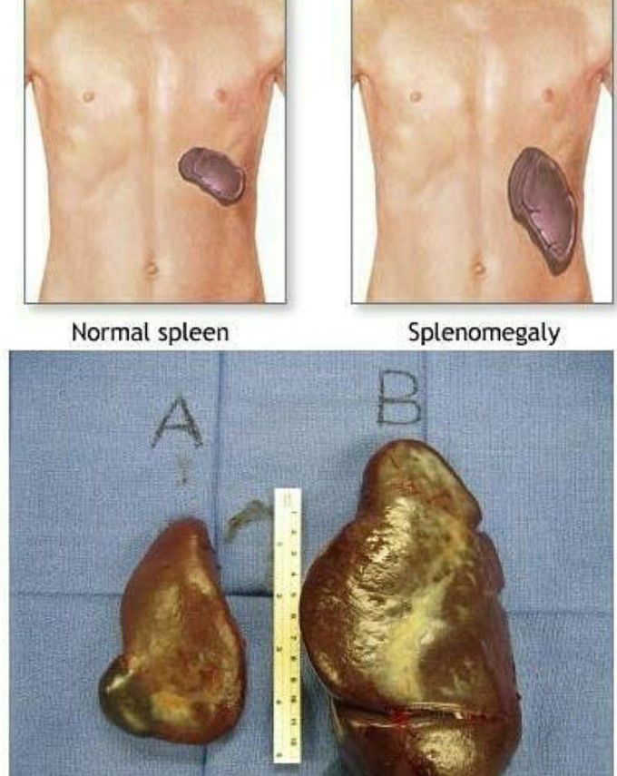 Name any good cause of splenomegaly u know