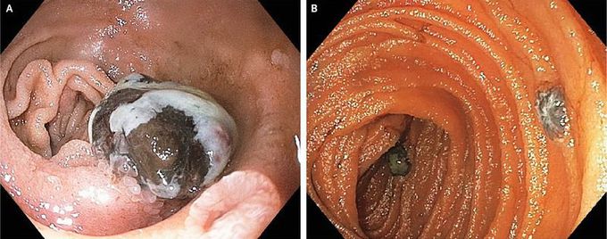Melanoma Metastatic to the Duodenum