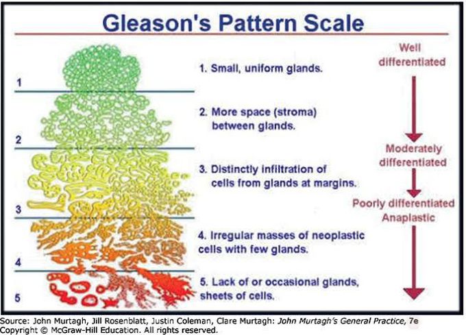 Gleason's Pattern Scale